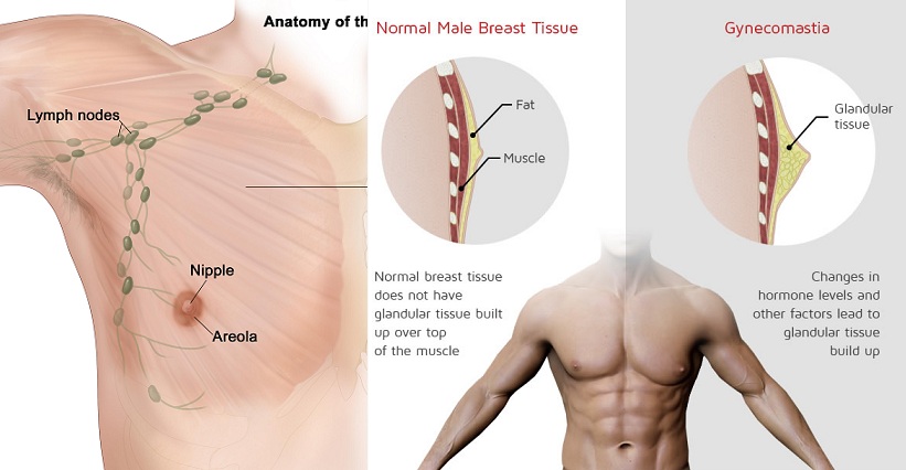 Gynecomastia