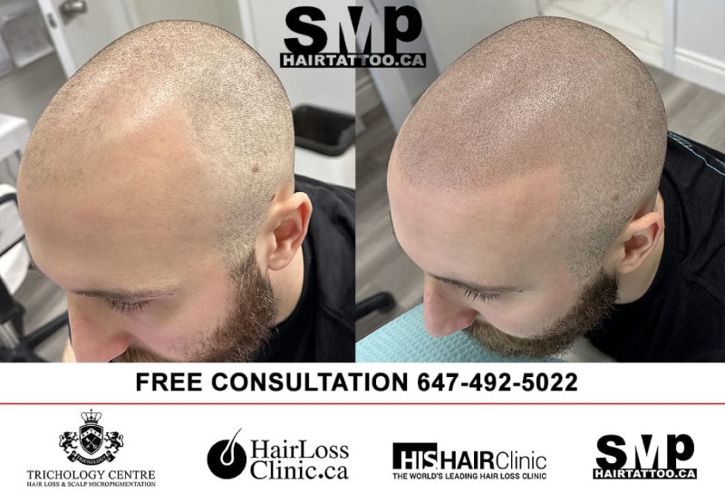 Scalp Micropigmentation | SMP hair tattoo in Toronto